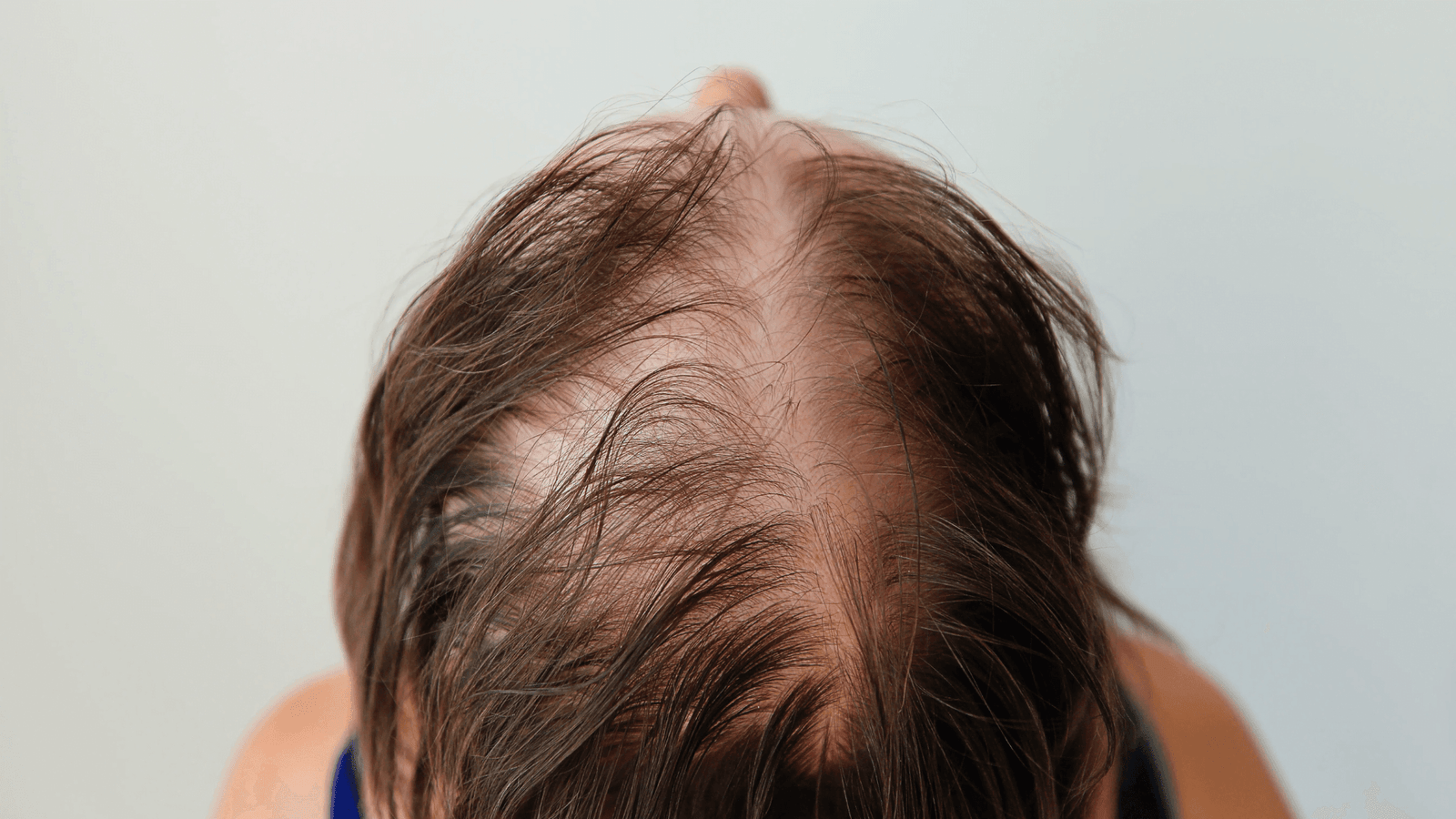New Alopecia Drug Enters Phase 2 – Could it Help Severe Cases?