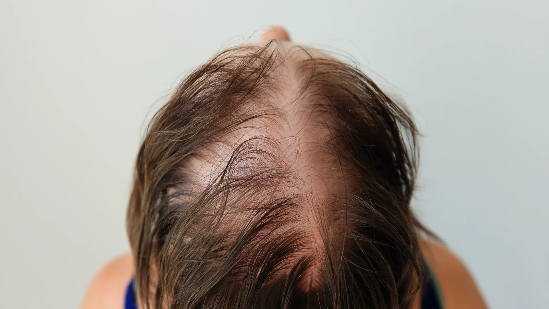New Alopecia Drug Enters Phase 2 Trials